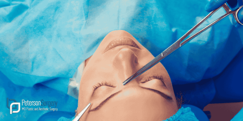 Top Benefits of Brow Lifts for Kelowna Clients: A Younger, Fresher Look 